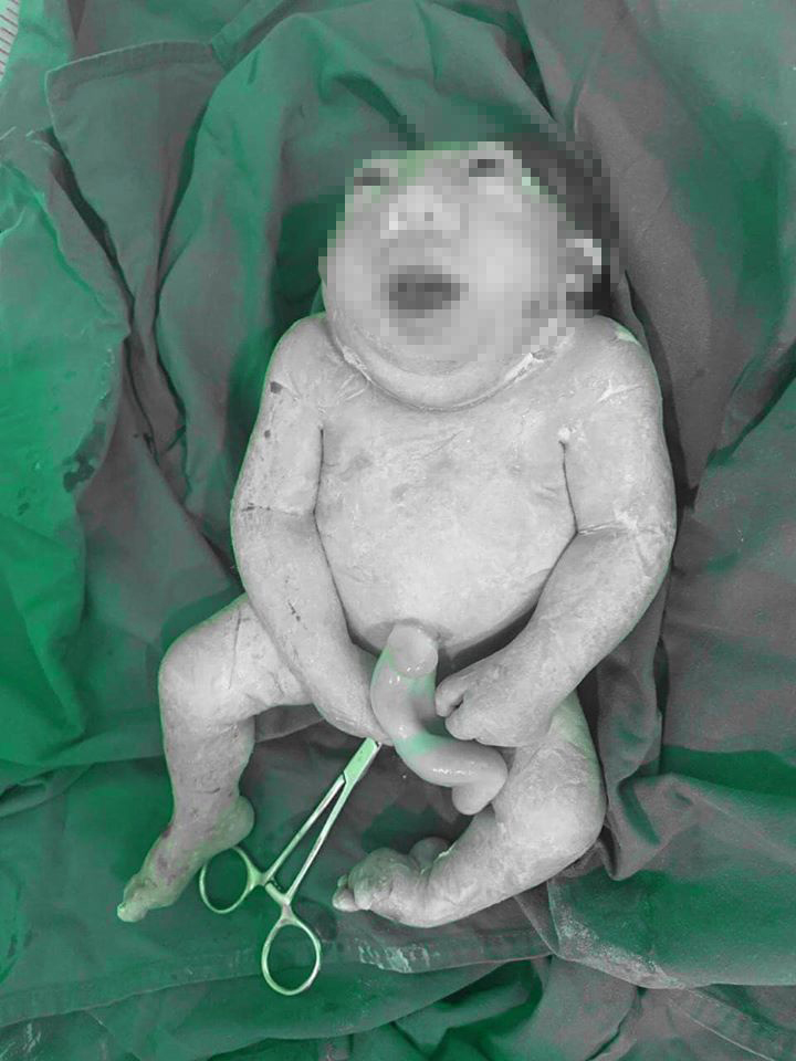 صور صادمة لولادة طفل يعانى من تشوهات خلقية فى العراق (1)