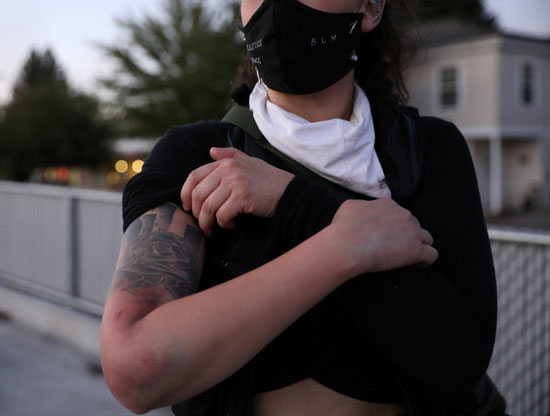 امرأة تظهر كدمات وجروح في ذراعها بسبب قذائف أطلقتها سلطات إنفاذ القانون