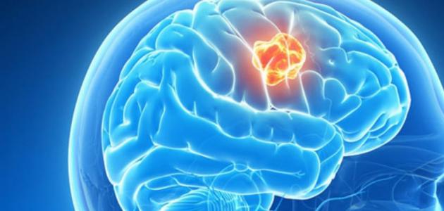 أعراض_ورم_الدماغ أعراض_ورم_الدماغ