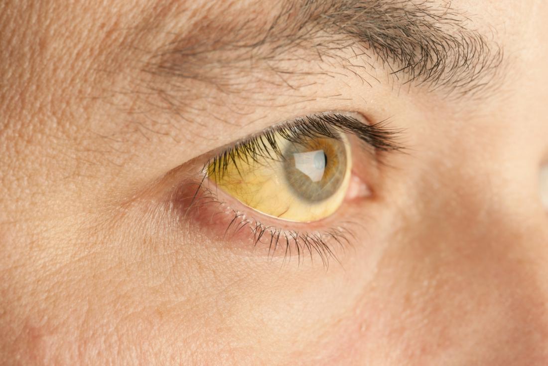jaundice-is-a-sign-of-yellow-fever