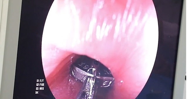 طفلة تنجو بعد إجراءها جراحة عقب ابتلاعها عملة معدنية يوان (2)