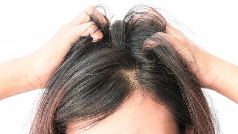 طرق طبيعية لعلاج قشرة الشعر