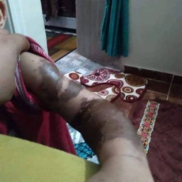 حروق بالطفل حروق بالطفل