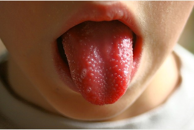 strawberry-tongue