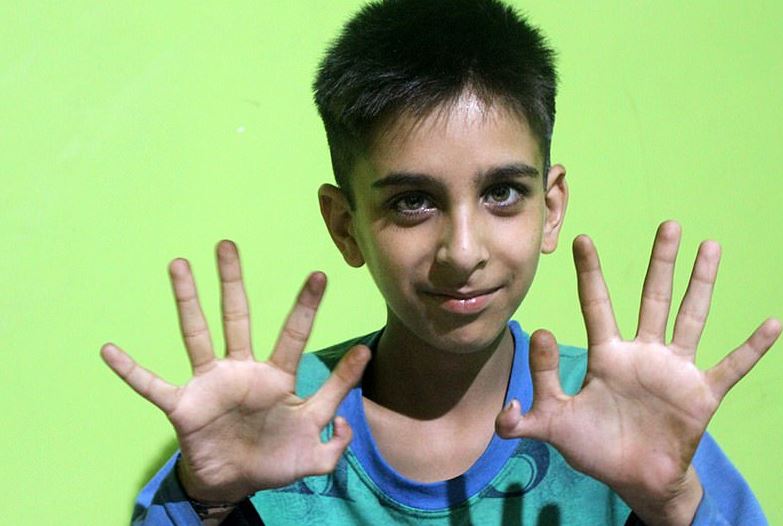 صورة أخرى توضح الإصبع السادس للفتى الهندى