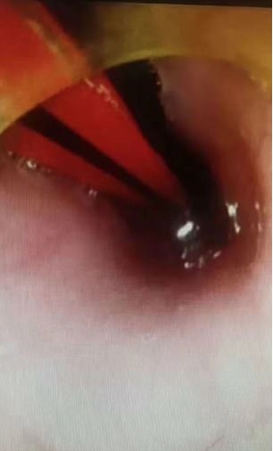 محاولة سحب القلم الرصاص من بطن الطفل خلال العملية الجراحية