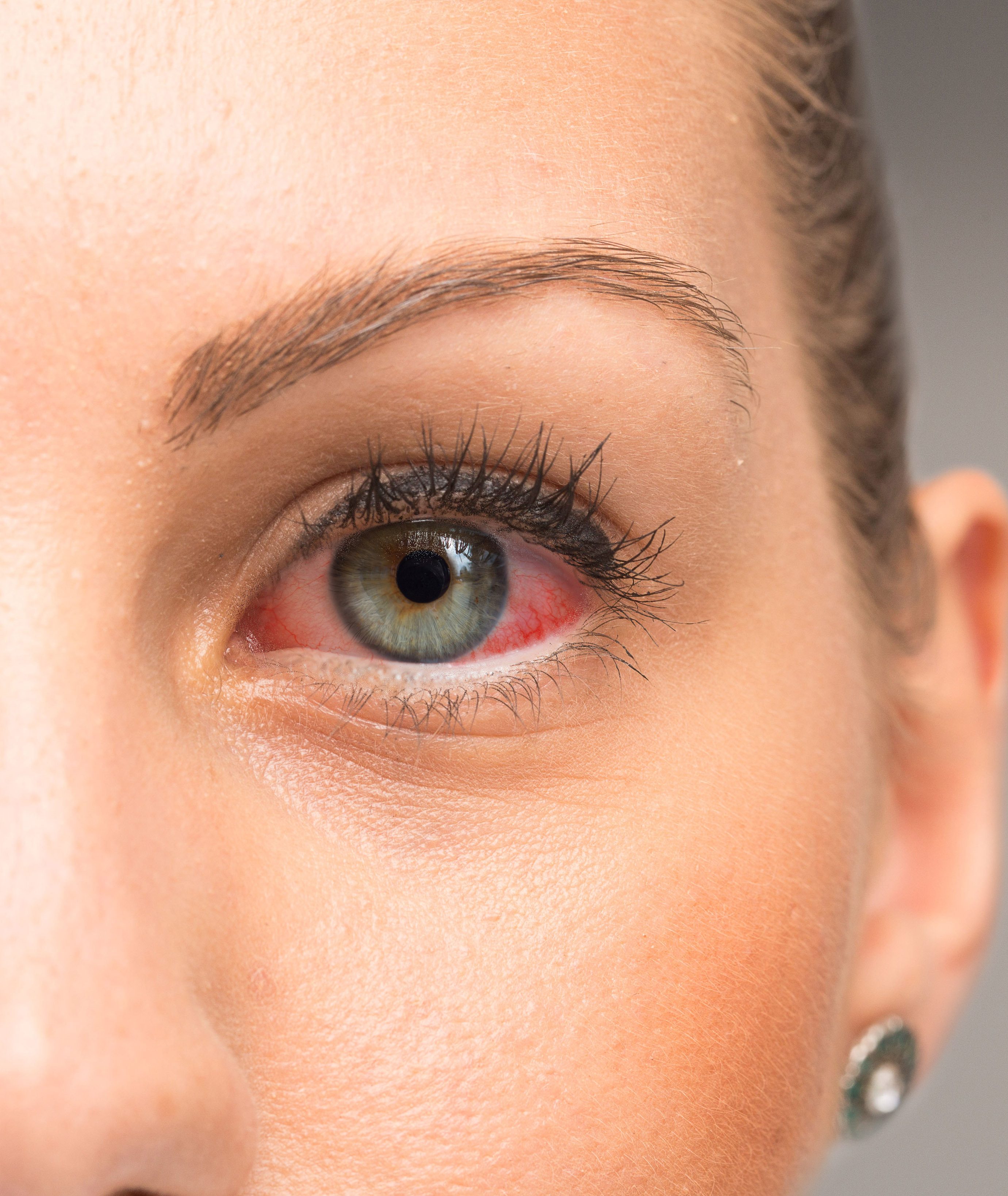اسباب احمرار العين عدة وأبرزها الحساسية أو التعرض لغبار - اليوم السابع