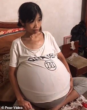 سيدة صينية تعاني من انتفاخ بطنها في حالة صحية غريبة (5)