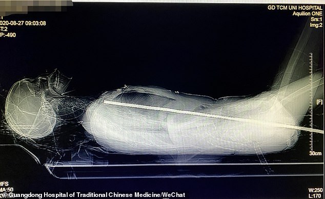 الأشعة السينية توضح اختراق سيخ الحديد جسد المرأة