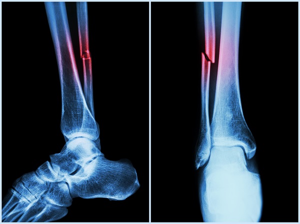 orthoatlanta_facts_about_bone_fractures_image_1-resize