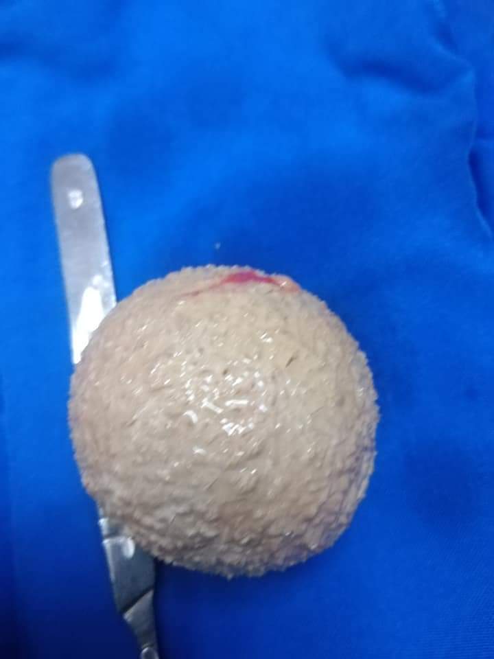  استخراج حصوة من مثانة مريض بحجم كرة التنس (2)