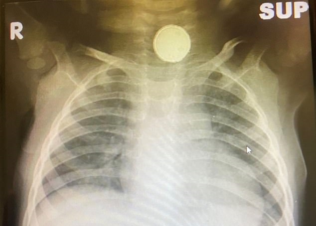 طفلة تنجو بعد ابتلاعها بطارية علقت في حلقها 4 شهور (1)