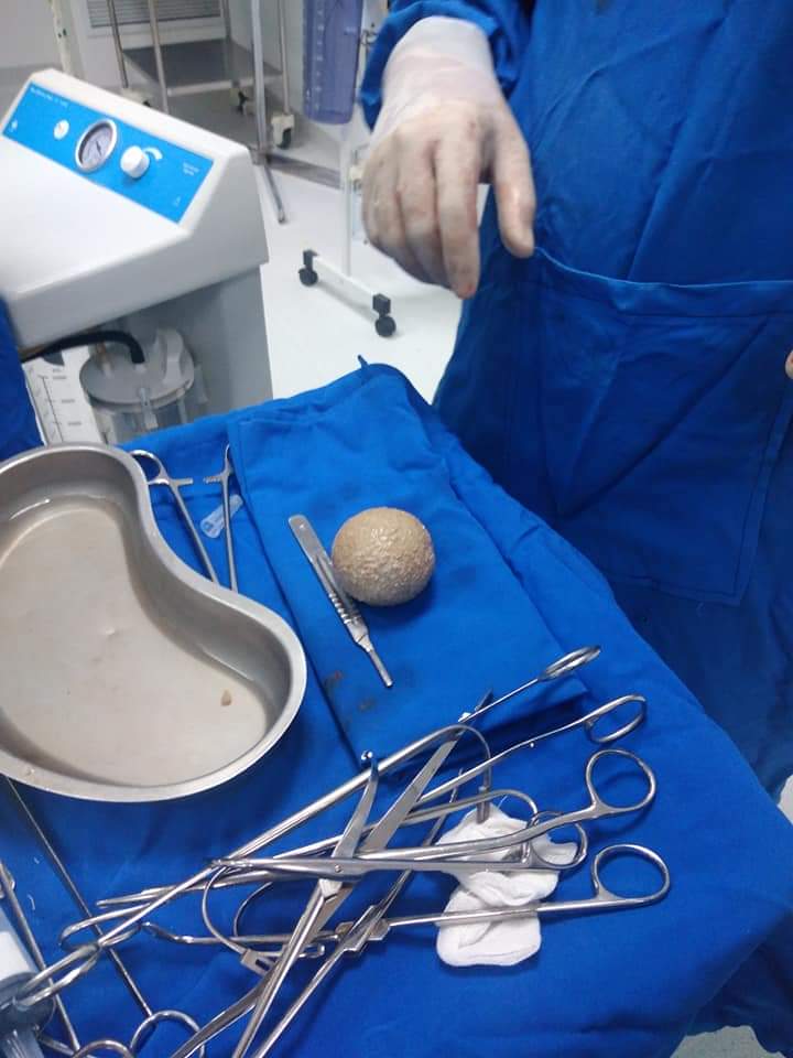  استخراج حصوة من مثانة مريض بحجم كرة التنس (3)