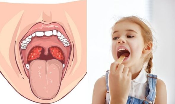 can-you-catch-tonsillitis-1361747