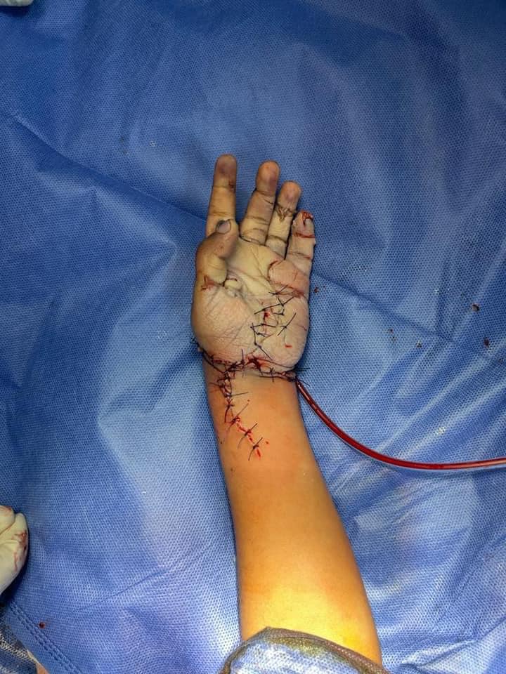 يد الطفلة بعد إخراجها من مفرمة اللحوم بغرفة العمليات
