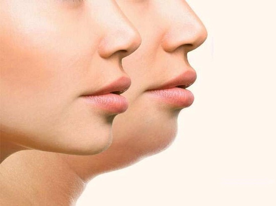 وصفات طبيعية للتخلص من دهون الوجه والذقن