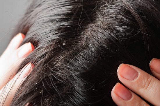 وصفات طبيعية لعلاج قشرة الشعر في المنزل