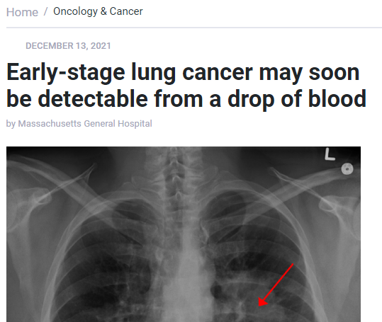 سرطان الرئة اكتشافه بنقطة دم