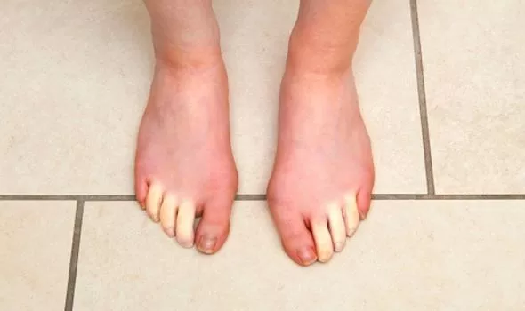 مرض رينود يغير لون اصابع القدمين
