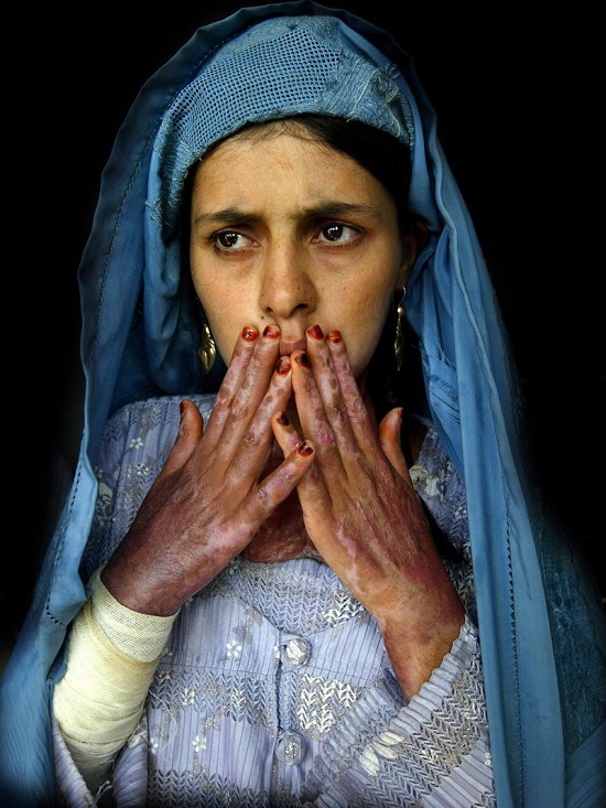 ماسوما فتاة أفغانية تعاني من حروق شديدة بسبب التضحية بالنفس