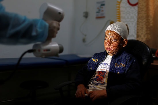 أخصائي علاج طبيعي يقوم بمسح وجه الطفل الفلسطيني أحمد الديب