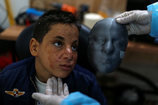 الفلسطيني أحمد الديب يرتدي قناع وجه شفاف ثلاثي الأبعاد