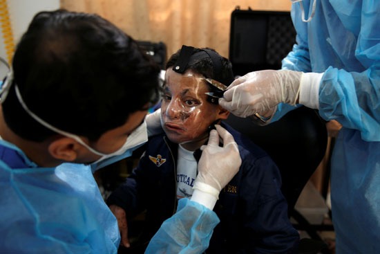 أخصائيو العلاج الطبيعي يضعون قناعًا على وجه الطفل الفلسطيني أحمد الديب