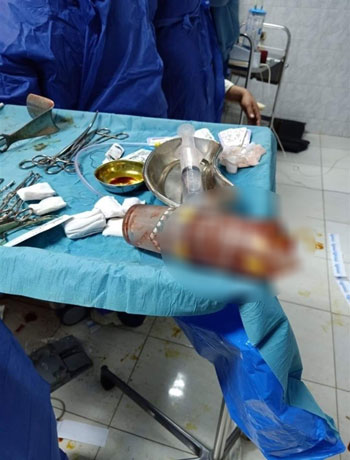 استخراج كوبايتين زجاج من بطن مريض بمستشفى المنصورة (2)