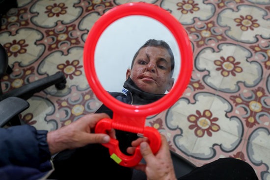 ضحايا الحروق في غزة يحصلون على أقنعة وجه بطابعة ثلاثية الأبعاد