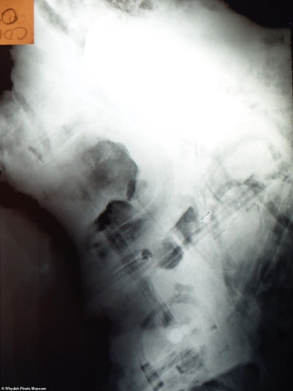 صورة بالأشعة السينية توضح العظام