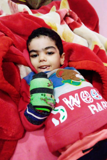 طفل مصاب بمرض نادر فى كفر الشيخ (1)