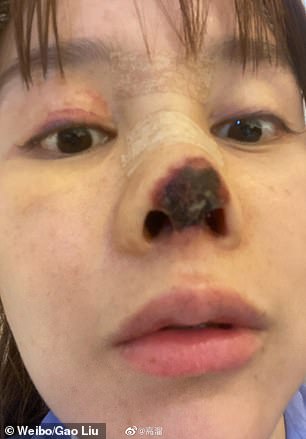 خضعت الممثلة الصينية عسكرية في الأنف تضمنت إزالة غضروفها