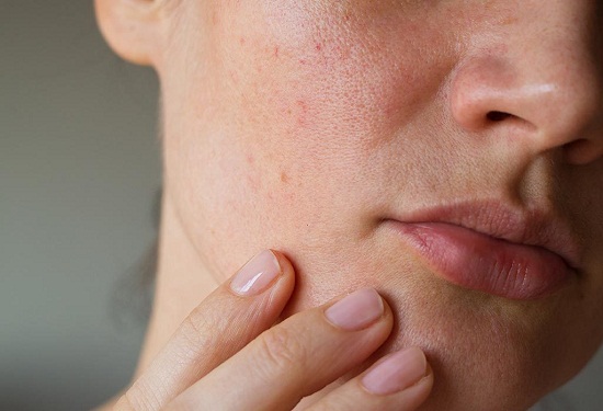 وصفات طبيعية لعلاج ثقوب الوجه