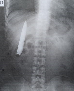 شاب يكتشف نصل سكين داخل جسده بعد 15 شهر من خناقة في الفلبين (3)