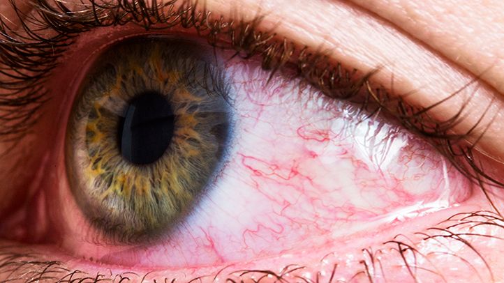 اسباب حساسية العين