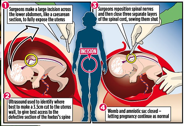 اجراء عملية للجنين قبل الولادة