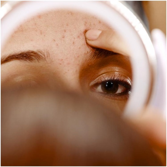 وصفات طبيعية لعلاج البثور في الوجه (4)