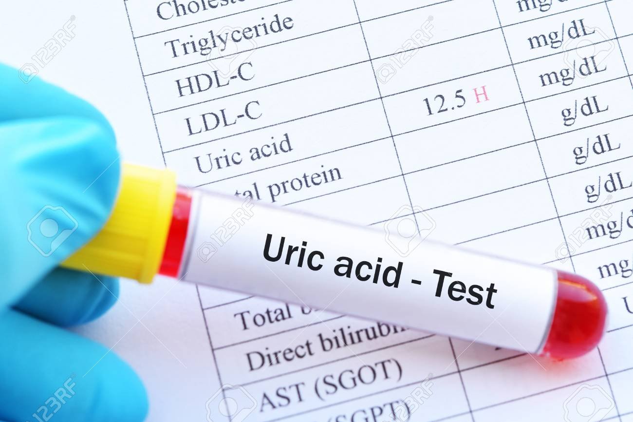 106096749-blood-sample-tube-with-abnormal-high-uric-acid-test-result