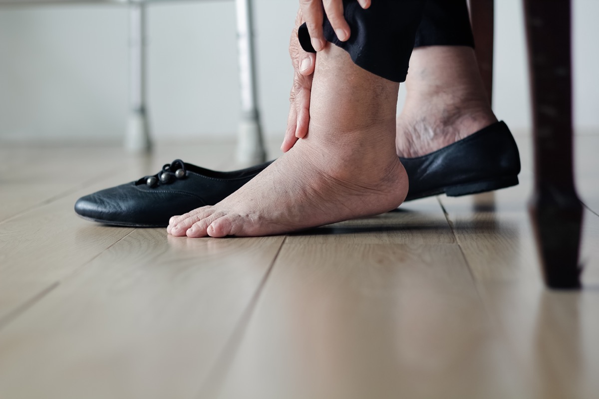 woman-swollen-foot-ankle