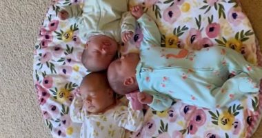 ولادة 3 توائم متطابقين في حالة نادرة