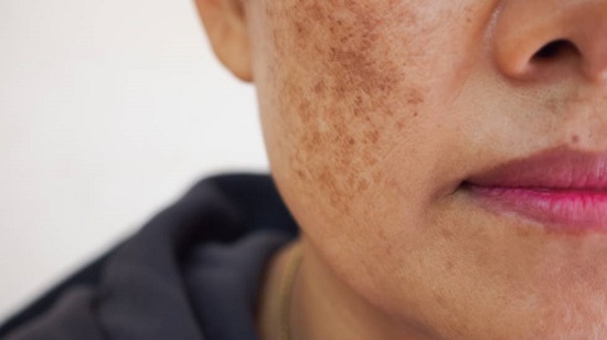 Natural recipes to remove freckles from the face