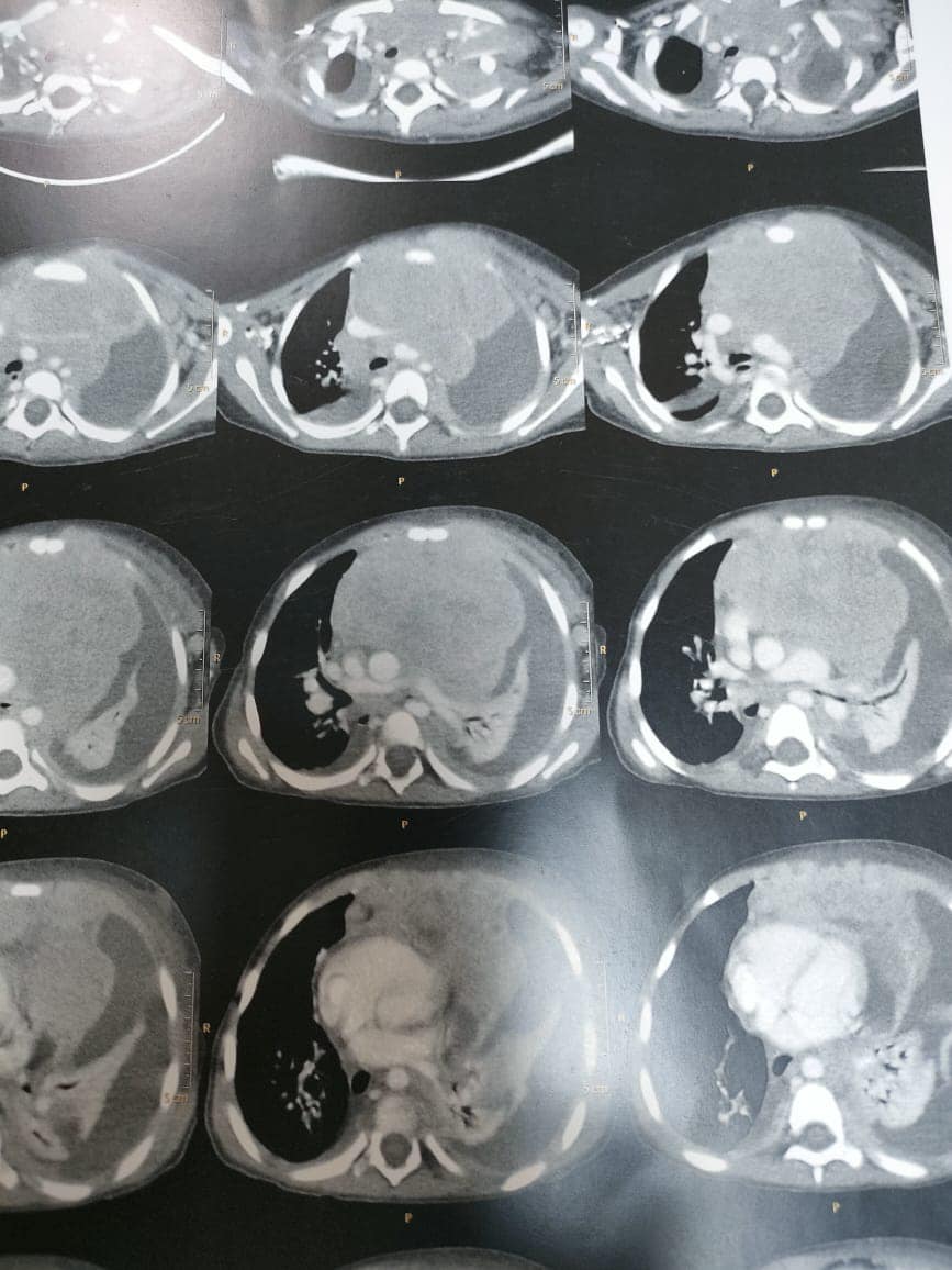 الورم يظهر بالأشعة الخاصة بالطفلة