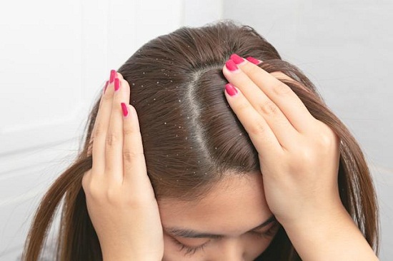 طرق طبيعية لعلاج قشرة الشعر فى المنزل طرق طبيعية لعلاج قشرة الشعر فى المنزل