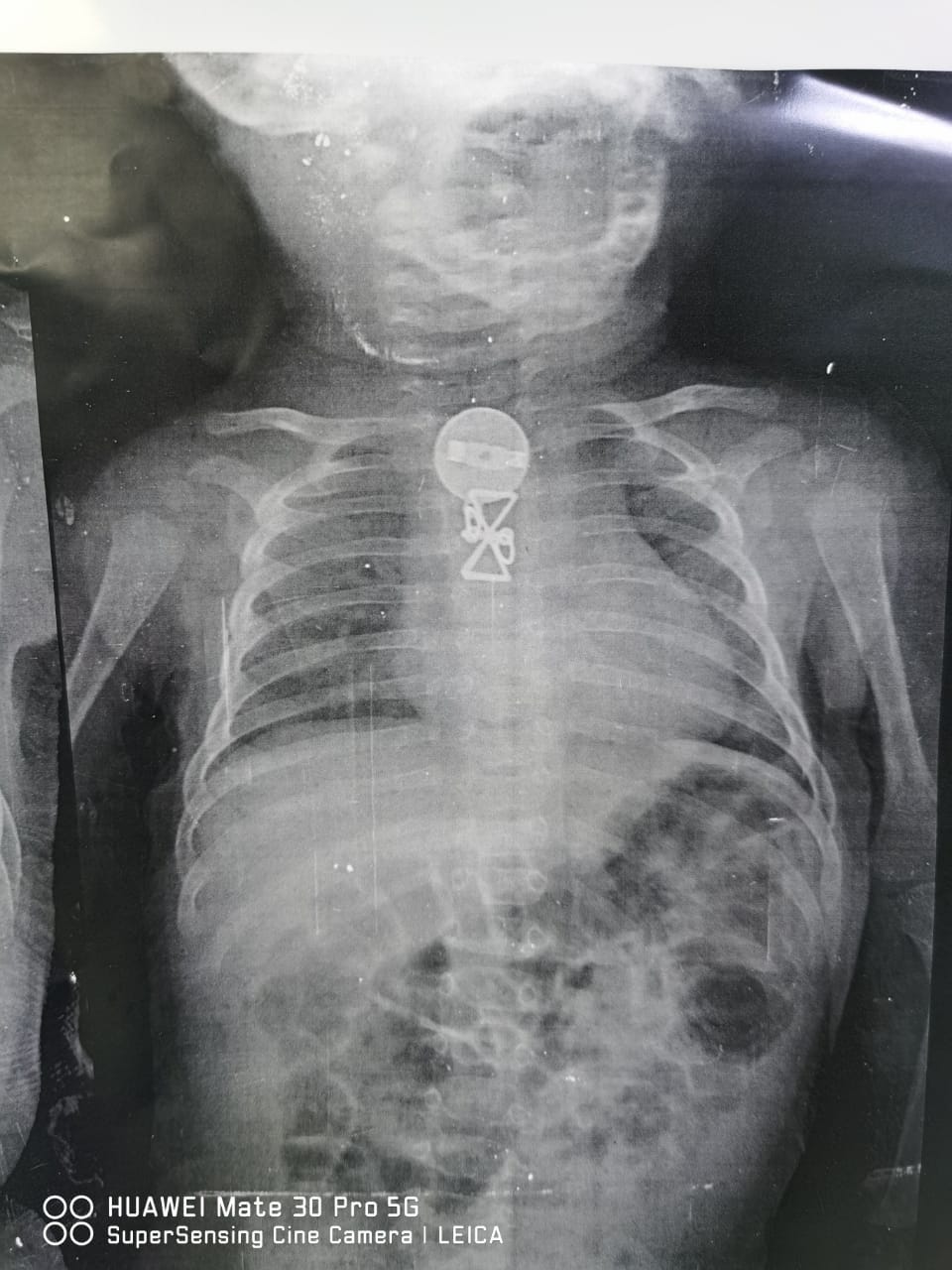 الأشعة توضح الحلق بصدر الطفل