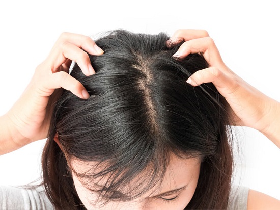 وصفات  لعلاج قشرة الشعر