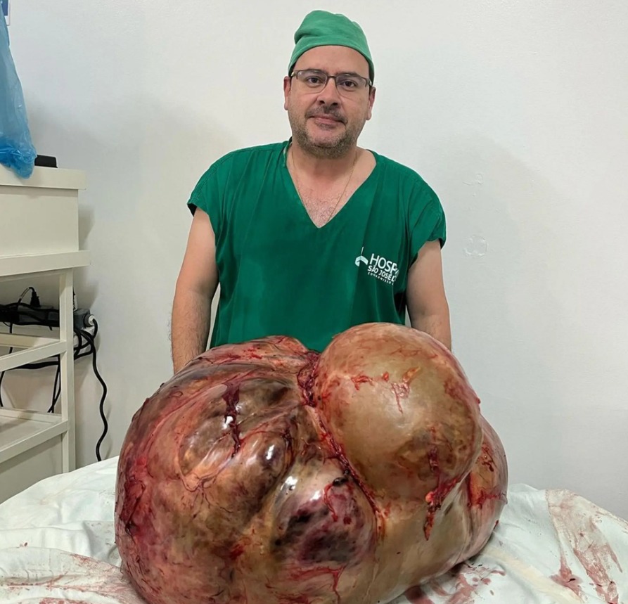 إزالة ورم ضخم وزنه 45 كيلو من سيدة برازيلية عاشت به 5 سنوات اليوم السابع