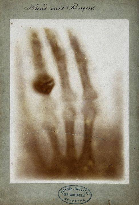 أول صورة بالأشعة السينية التقطها رونتجن ليد زوجته بيرثا