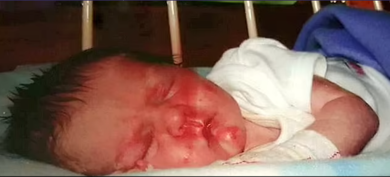 اصيب بالحالة بعد ولادته