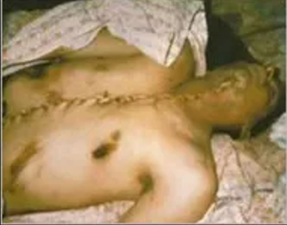 جثمان الشهيد بلال غانم بعد سرقة الاحتلال لأعضائه البشرية