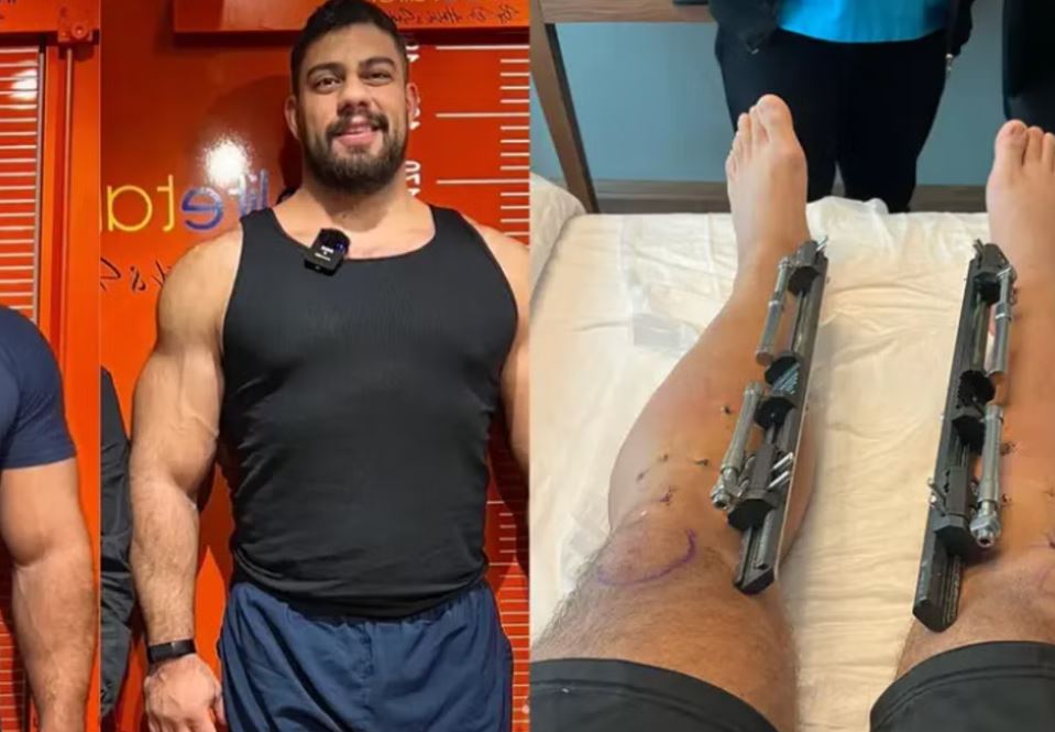 A man undergoes surgery to increase his height
